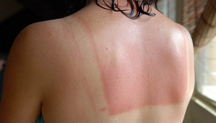 Tips Cepat Mengatasi Sunburn dengan Bahan Alami